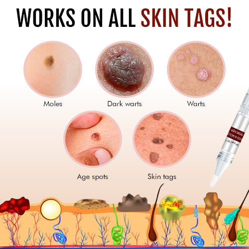 Tags & Moles Remover - Buy 1 Get 1 Free Sale Live🔥