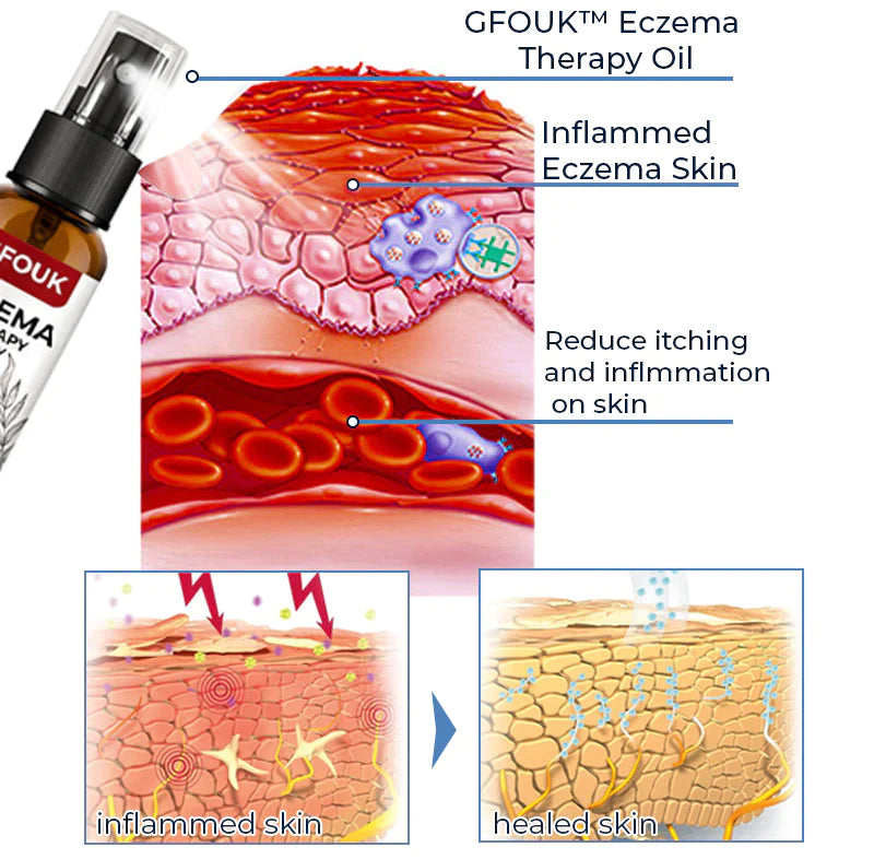 Last Day Promotion 70% OFF - 🔥Eczema Therapy Spray